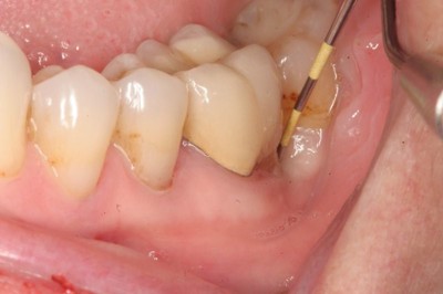 Viêm quanh răng tiến triển chậm là gì? Xem ngay cách khắc phục mới từ thảo dược! 