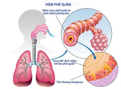 Bảo Phế Vương có tác dụng như thế nào trong điều trị viêm phổi, viêm phế quản?