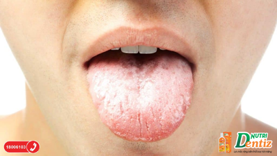 Miệng hôi lưỡi trắng là gì? Cách khắc phục ra sao? 