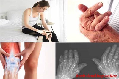  Đau nhức, cứng các khớp bàn - ngón tay là bị bệnh gì? Nên điều trị ra sao