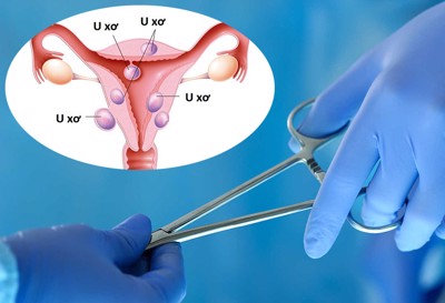 Kích thước u xơ tử cung như thế nào thì cần phẫu thuật? Phương pháp này có gây ảnh hưởng gì không?