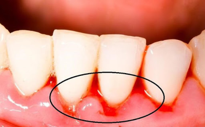 Chảy máu chân răng là bệnh gì? Điều trị như thế nào?