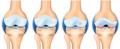 Cách sử dụng Hoàng Thấp Linh hiệu quả, giúp cải thiện viêm khớp dạng thấp, thoái hóa khớp.