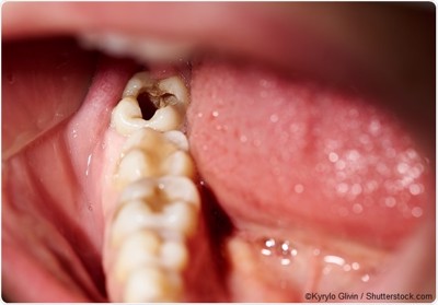 Nguyên nhân dẫn tới tình trạng hôi miệng, viêm sưng lợi, chảy máu chân răng là gì?