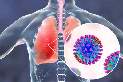 Nguyên nhân gây viêm phổi, viêm phế quản và biến chứng của bệnh là gì?