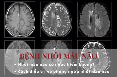 Bệnh đột quỵ nhồi máu não là gì?