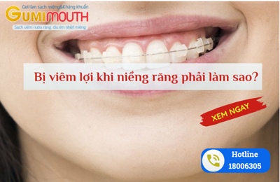 Bị viêm lợi khi niềng răng phải làm sao? Xem ngay cách khắc phục