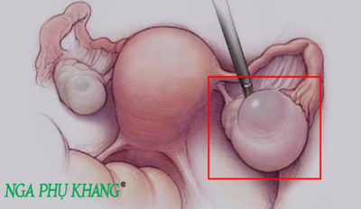 Vỡ u nang buồng trứng nếu không cấp cứu và xử lý kịp thời sẽ gây nguy hiểm thế nào cho người bệnh?