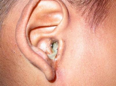 Người già bị nặng tai và trẻ nhỏ bị viêm tai giữa phải điều trị thế nào?