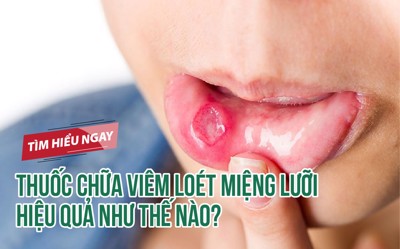Thuốc chữa viêm loét miệng lưỡi hiệu quả như thế nào? TÌM HIỂU NGAY!