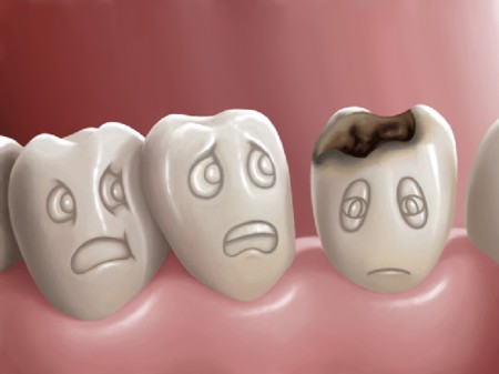 Hiểm họa khôn lường từ sâu răng