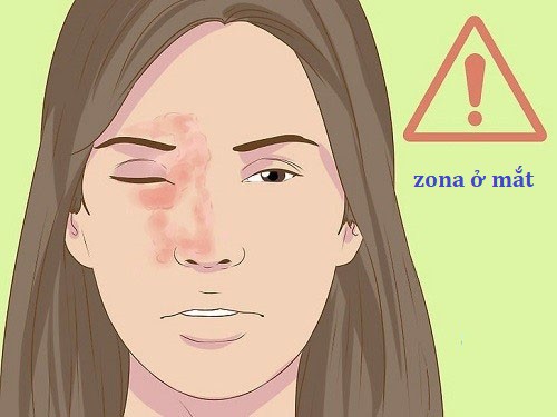 Bệnh zona thần kinh ở mắt kiêng gì cho nhanh khỏi? 