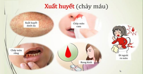 Chảy máu cam khi bị sốt xuất huyết có nguy hiểm không? 