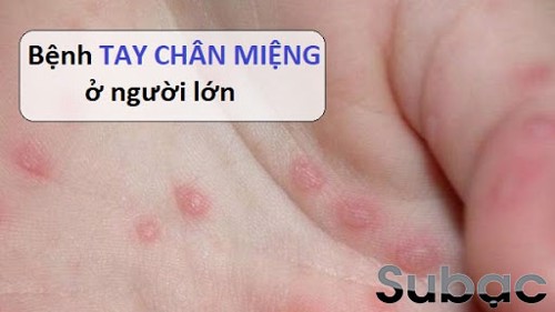 Bệnh tay chân miệng có lây cho người lớn không? Mách bạn cách cải thiện hiệu quả từ thảo dược