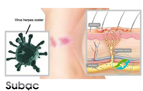 Cách chữa zona thần kinh theo dân gian và giải pháp cải thiện hiệu quả từ thảo dược