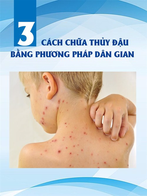 3 cách chữa thủy đậu bằng phương pháp dân gian