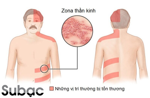 Bệnh zona thần kinh ở người cao tuổi và giải pháp cải thiện hiệu quả từ thảo dược