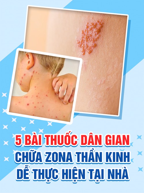 5 bài thuốc dân gian chữa zona thần kinh dễ thực hiện tại nhà