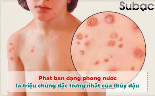 TẠI SAO CỐM SUBẠC VÀ GEL SUBẠC LẠI ĐƯỢC SỬ DỤNG TRONG HỖ TRỢ ĐIỀU TRỊ THỦY ĐẬU?