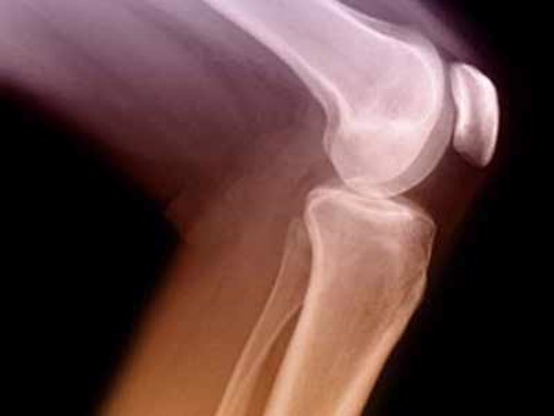 Bệnh viêm khớp dạng thấp liên quan tới cân nặng?