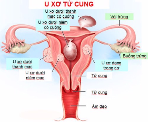 7 triệu chứng bệnh u xơ tử cung chị em tự nhận biết