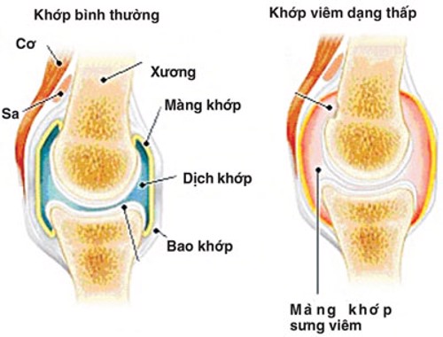 Nguy cơ mắc ung thư khi bị bệnh viêm khớp dạng thấp