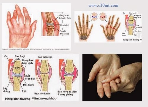   Hướng đi mới trong điều trị viêm khớp dạng thấp