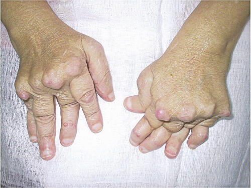 Đề phòng biến dạng khớp do viêm khớp dạng thấp