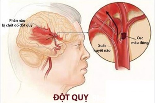 Độ quỵ não là gì-bạn có biết?