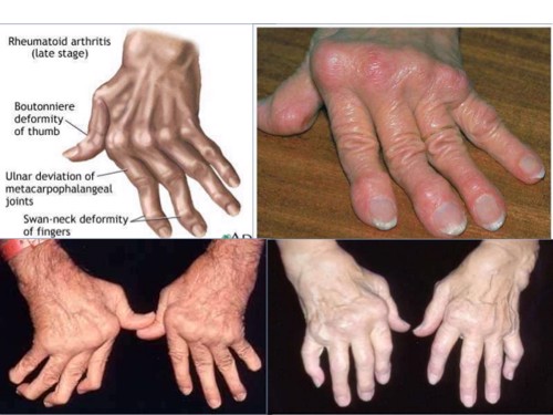 Đau khớp đối xứng- Dấu hiệu nhận biết viêm khớp dạng thấp