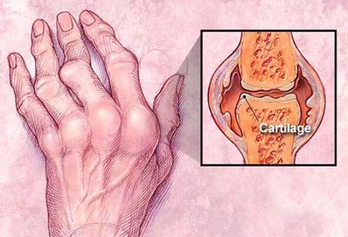 Kết hợp điều trị viêm khớp dạng thấp bằng thuốc y học cổ truyền và Hoàng Thấp Linh