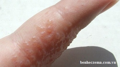 Tìm hiểu những triệu chứng của bệnh eczema