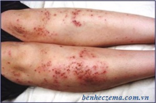 Nghiên cứu mới về biến chứng bệnh eczema