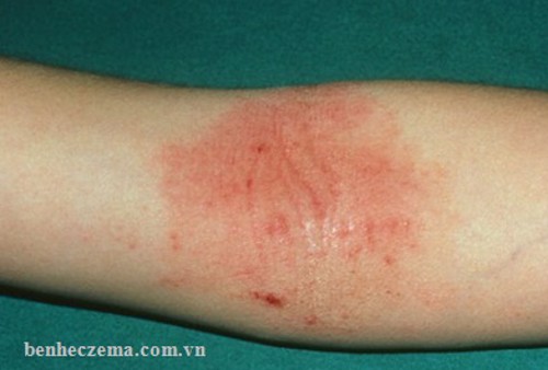 Bệnh Eczema - Giải pháp phòng ngừa và điều trị toàn diện