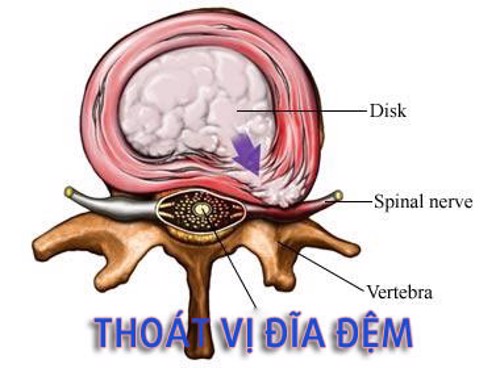 2 LỜI KHUYÊN CỦA BÁC SĨ MINH TÂM GIÚP ĐIỀU TRỊ THOÁT VỊ ĐĨA ĐỆM HIỆU QUẢ