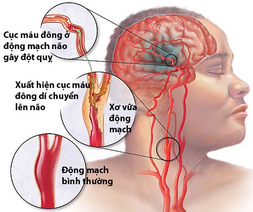 BS CKI Nguyễn Hồng Hải Giải Đáp Phương Pháp Phòng Ngừa Đột Quỵ Não Tái Phát