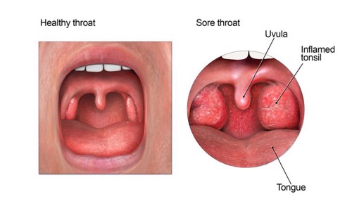 Nguyên nhân viêm amidan và cách giảm sưng đau họng hiệu quả