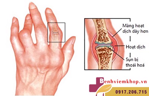 ĐỪNG ĐÙA: Viêm khớp dạng thấp có thể gây ung thư đấy!