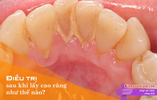 Điều trị sau lấy cao răng cần lưu ý những gì? 