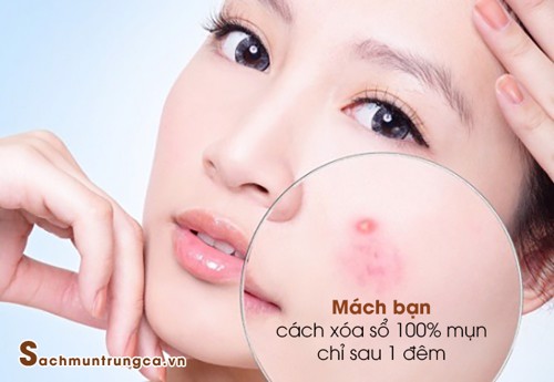 Mách bạn cách "xóa sổ"100% mụn chỉ sau 1 đêm