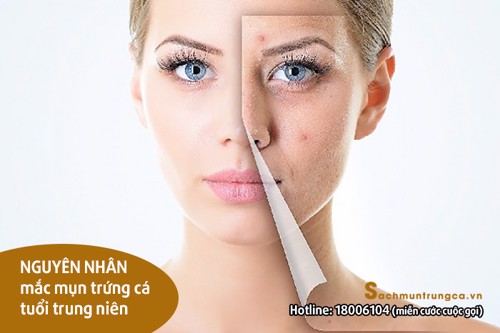 10 người bị mụn trứng cá tuổi trung niên thì đến 9 người mắc phải 5 nguyên nhân này