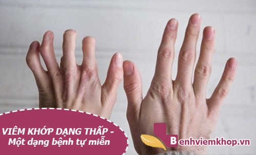 Tại sao viêm khớp dạng thấp lại là 1 dạng bệnh tự miễn? XEM NGAY kẻo phí!