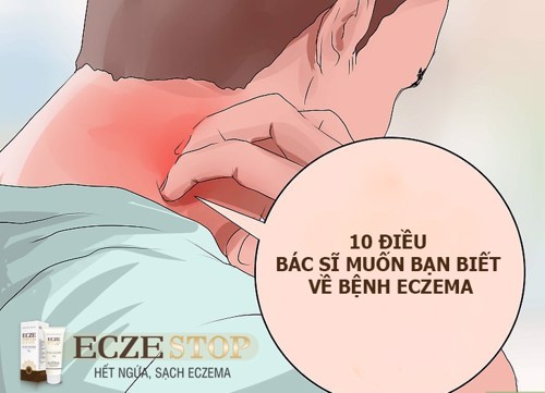 10 điều bác sĩ muốn bạn hiểu về "kẻ ngoại tộc" ECZEMA