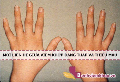 VIÊM KHỚP DẠNG THẤP gây thiếu máu. Tại sao lại như vậy?- Xem ngay!