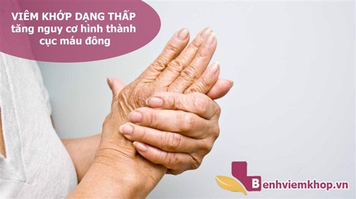 Cảnh báo: VIÊM KHỚP DẠNG THẤP làm gia tăng nguy cơ hình thành CỤC MÁU ĐÔNG