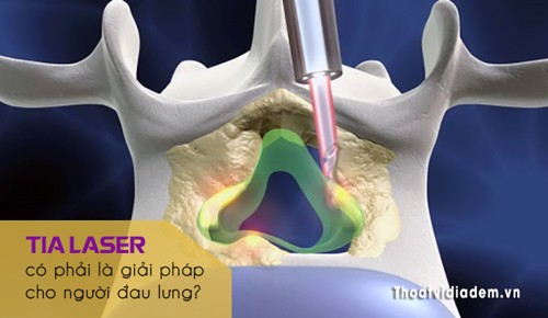 Tia laser liệu có phải là biện pháp cứu cánh cho người bị chứng đau lưng "bám dai như đỉa" 