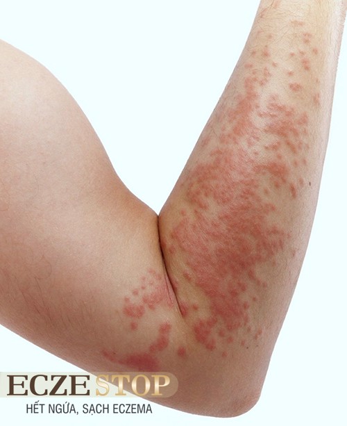 PHÁT HIỆN MỚI: Loại kem chứa vi khuẩn có thể là giải pháp hiệu quả điều trị ECZEMA