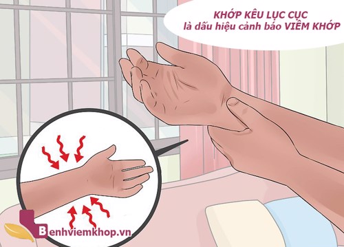 Triệu chứng bệnh VIÊM KHỚP biểu hiện khớp kêu "răng rắc" mỗi khi cử động có đúng không?