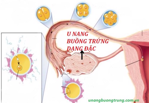 U nang buồng trứng dạng đặc và những thông tin về bệnh