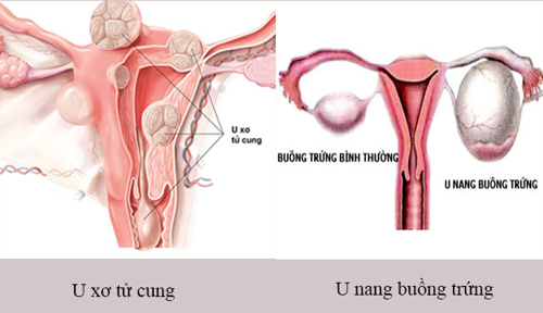 Các biện pháp điều trị u xơ tử cung u nang buồng trứng hiện nay là gì?